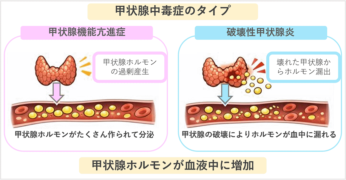 ①甲状腺ホルモンが過剰になる甲状腺中毒症画像
